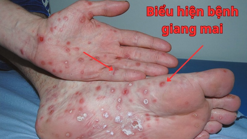 bệnh giang mai là gì