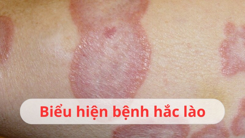 bệnh hắc lào là gì