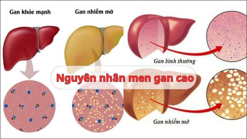 bệnh men gan cao là gì