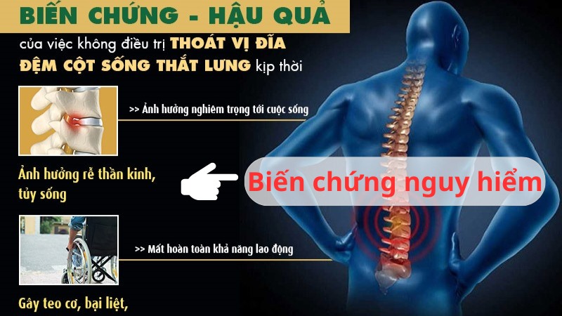 biến chứng thoát vị đĩa đệm