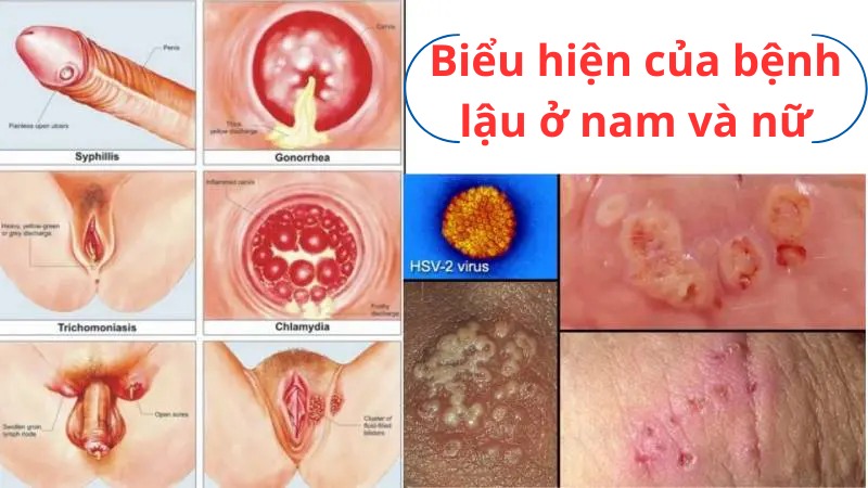 biểu hiện của bệnh lậu là gì