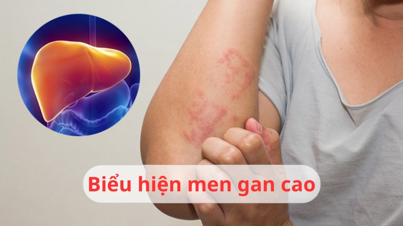 biểu hiện men gan cao