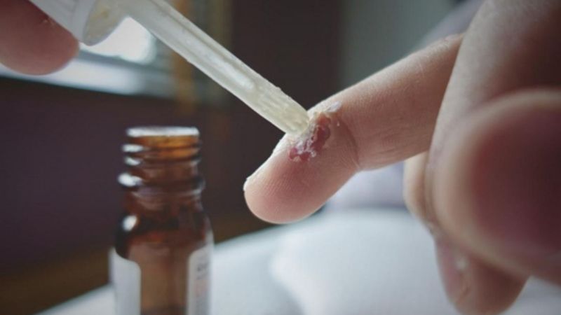 bôi acid salicylic trị mụn cóc