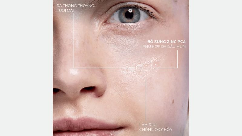 các loại da dễ bị mụn