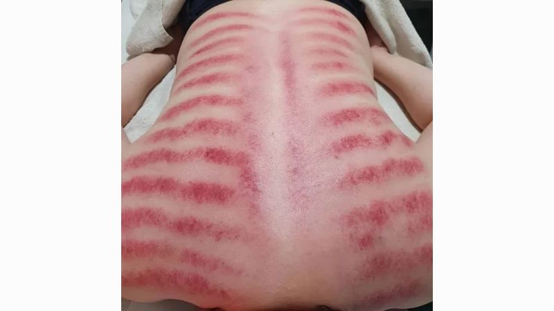 cách cạo gió chữa bệnh