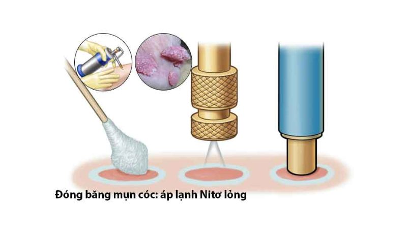 chấm nito lỏng trị mụn