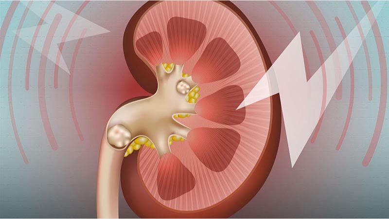 dấu hiệu nguyên nhân sỏi thận