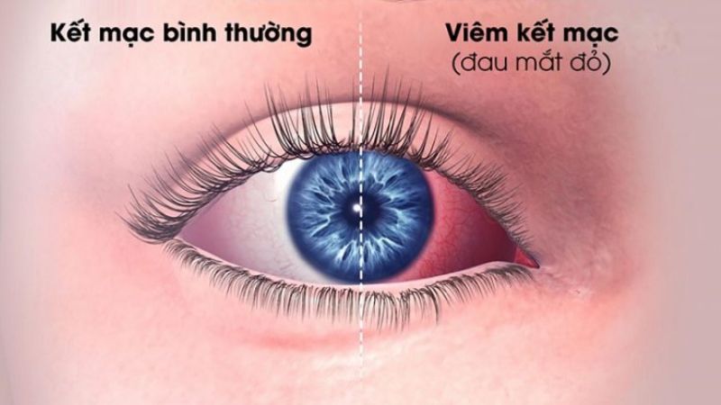 đau mắt đỏ do kích ứng