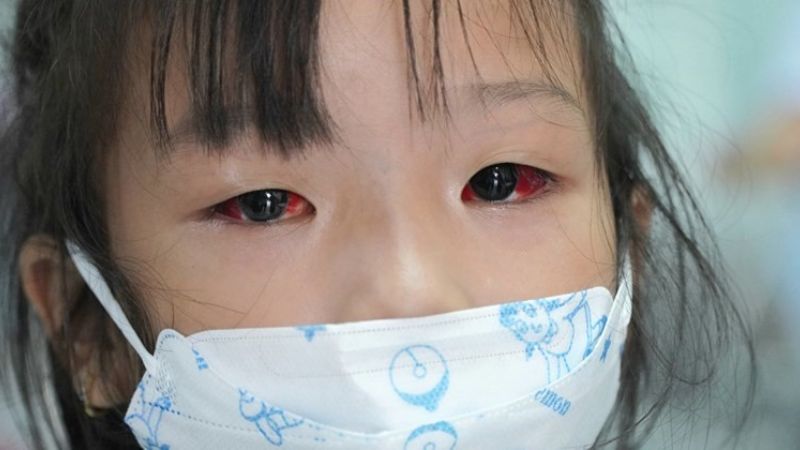 đau mắt đỏ do vi khuẩn