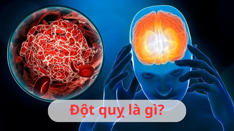 đột quỵ là gì