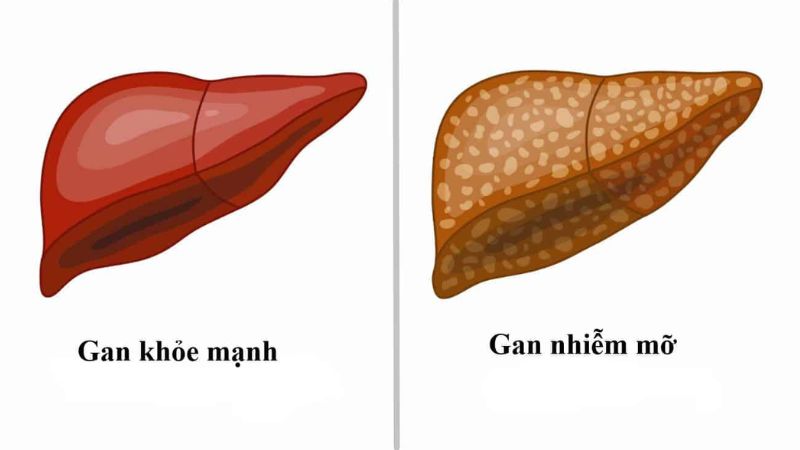 Cách trị gan nhiễm mỡ tại nhà an toàn, hiệu quả lâu dài