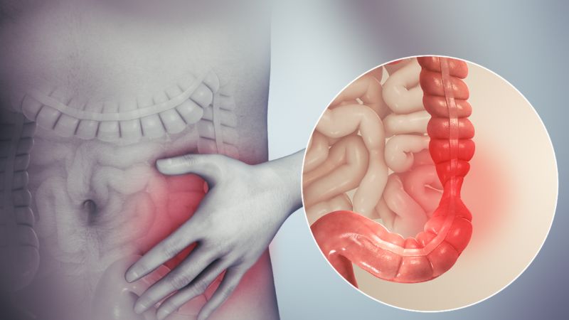 hội chứng ruột kích thích đau quặn bụng