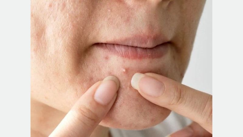 Cách trị mụn giảm mụn hiệu quả ngay tại nhà với những phương pháp khoa học