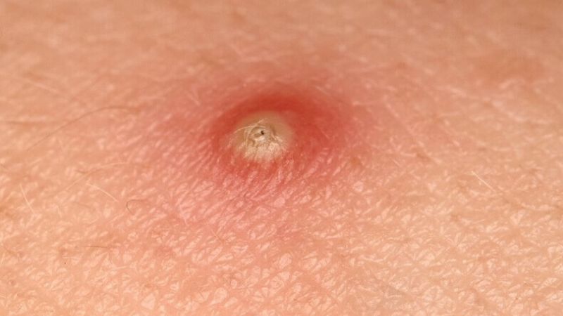 mụn nhọt do tắc nghẽn lỗ chân lông