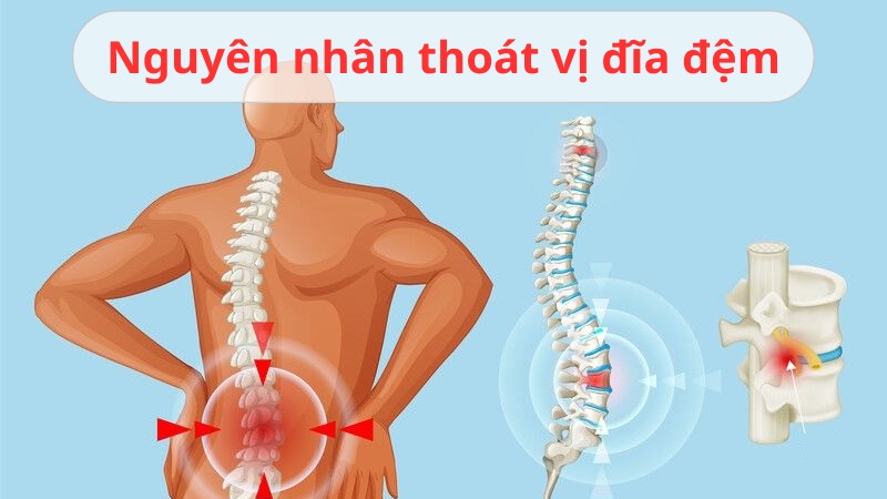 nguyên nhân thoát vị đĩa đệm là gì