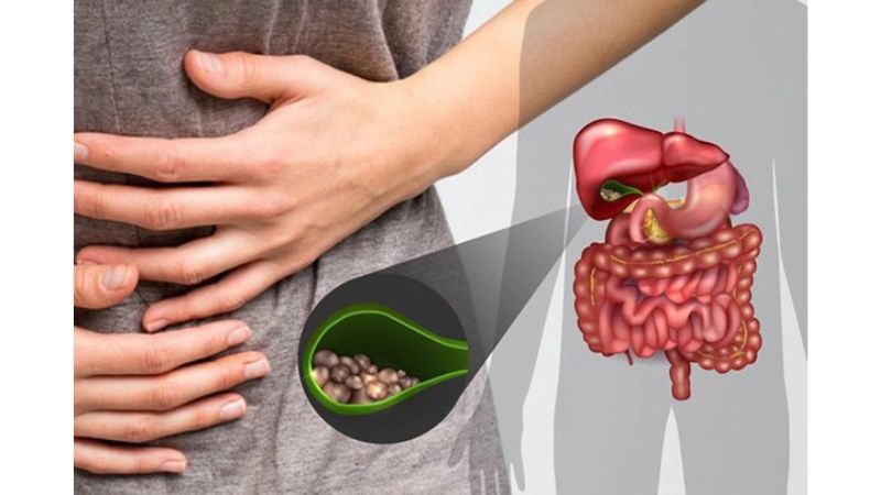 sỏi mật gây đau bụng