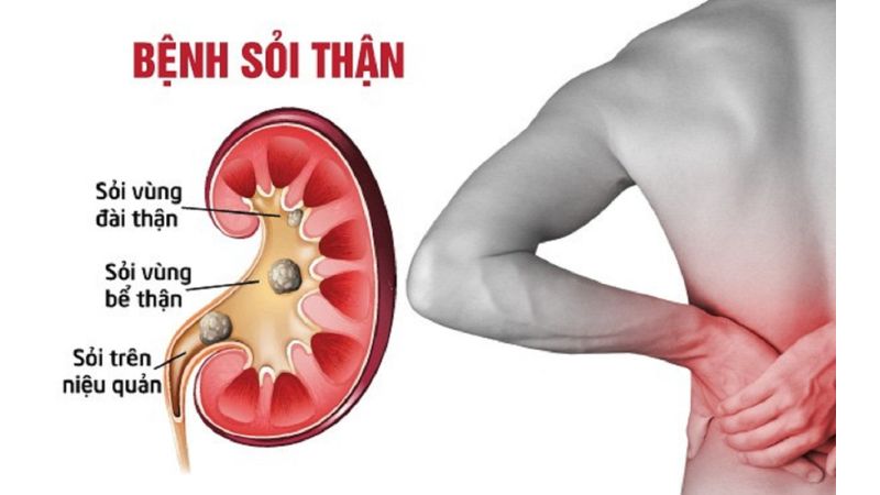 sỏi thận là bệnh gì