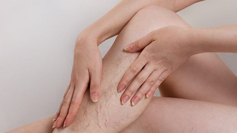 Cách trị giãn tĩnh mạch chân tại nhà an toàn hiệu quả nhanh chóng