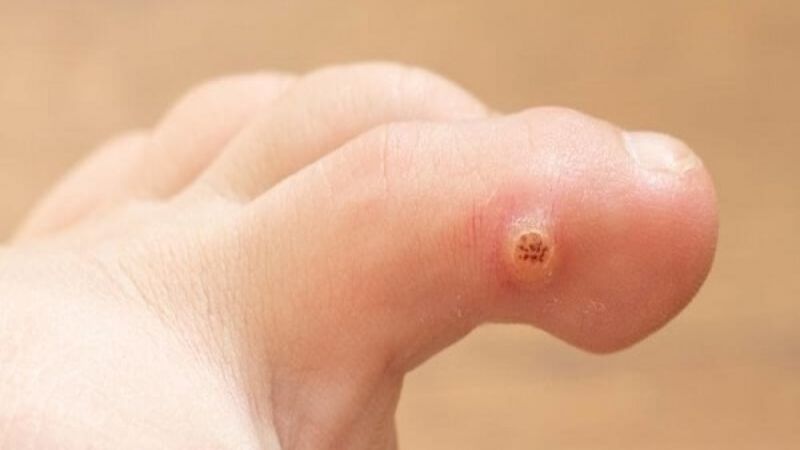 tìm hiểu về mụn cóc