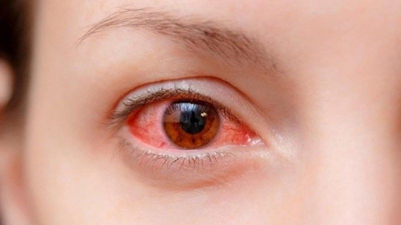 Cách chữa đau mắt đỏ nhanh chóng tại nhà