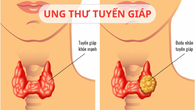 vai trò của tuyến giáp là gì