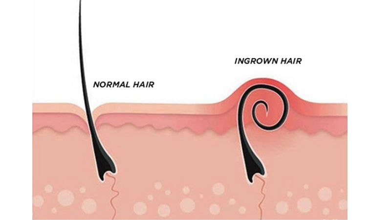 viêm nang lông do vi khuẩn