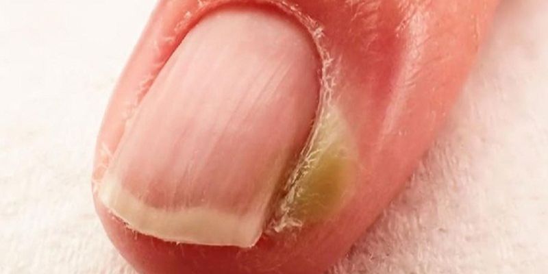 Cách chữa chín mé ở ngón chân cái hiệu quả bạn nên biết