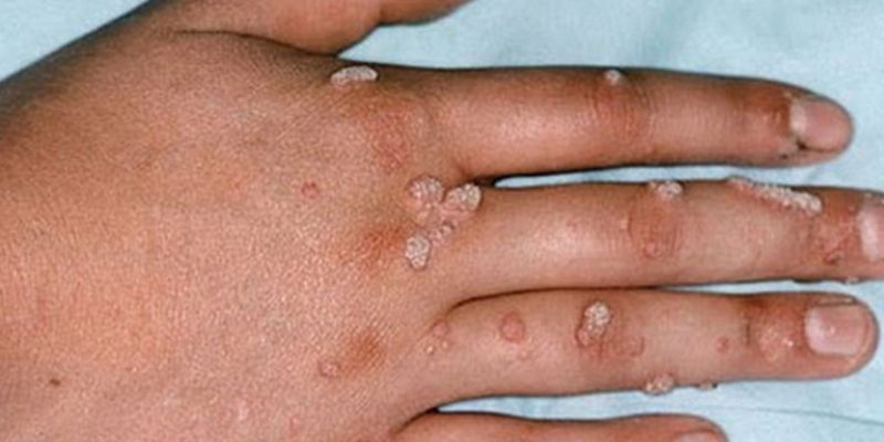 Top 13 cách chữa mụn cóc ở tay chân hiệu quả, an toàn tại nhà