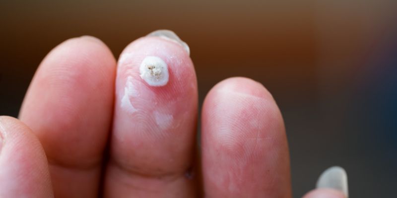 cách chữa mụn cóc ở tay chân