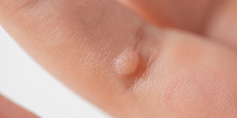 cách chữa mụn cóc ở tay